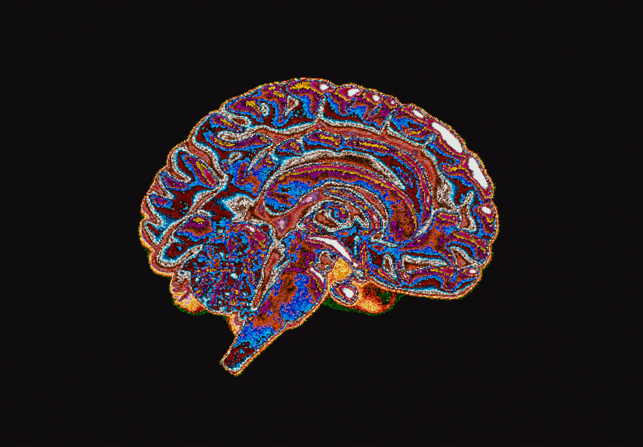 彩色插图显示了人类大脑的横截面。